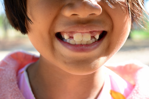 Criança, menina, mostrar, dente, cárie, quebrada, dente