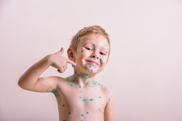Criança pequena, menino com catapora. Criança doente com varicela. Vírus da varicela ou erupção cutânea com bolhas de varicela no corpo e no rosto da criança.