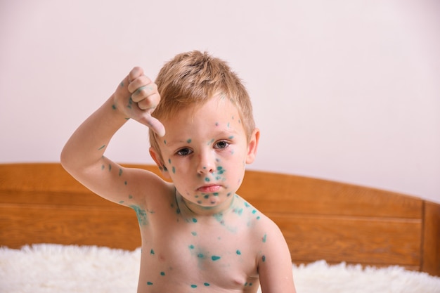 Criança pequena, menino com varicela. criança doente com varicela