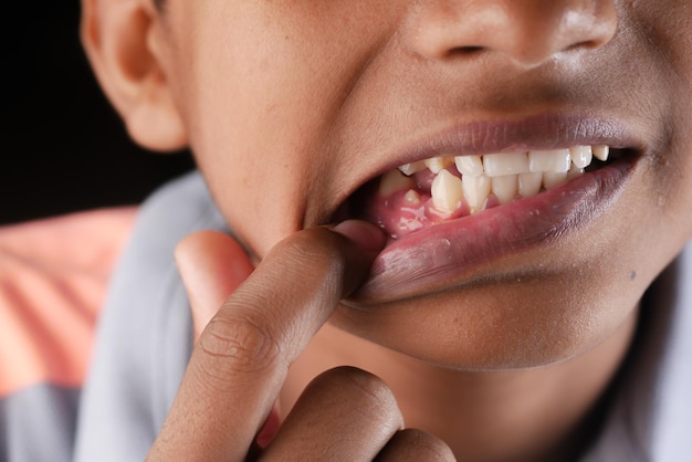 Criança sorrindo com dentes deformados