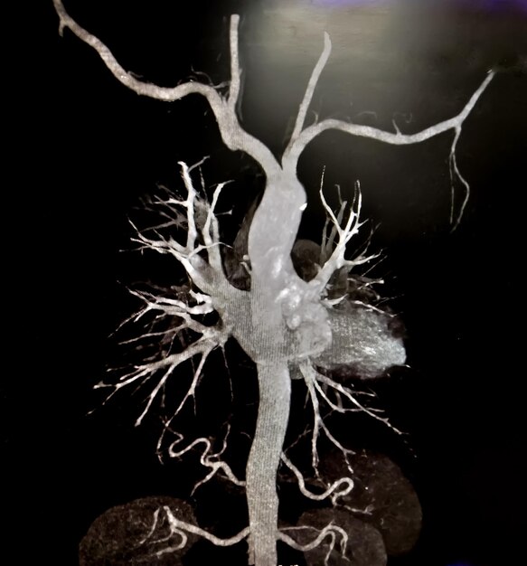 CT-Angiographie (Computertomographie-Angiographie: CTA) der abdominalen Aorta, Bauchruptur