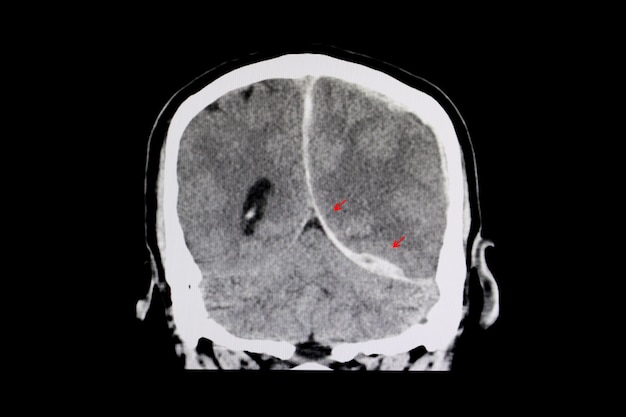 CT-Scan eines Gehirns eines Patienten mit interhemisphärischer Blutung