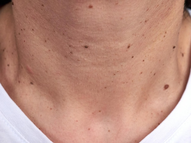 Cuello de una mujer con muchos pequeños lunares y verrugas