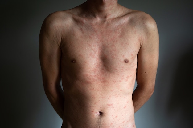 El cuerpo de un hombre adulto tiene manchas rojas y erupción de burbujas debido a la varicela o al virus de la varicela zóster. Complicaciones médicas después de una enfermedad.