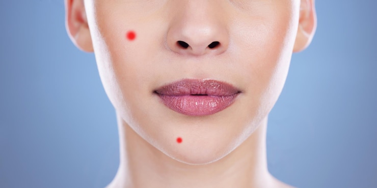 Foto cuidados com a pele acne rosto de mulher com manchas em estúdio para cosméticos bem-estar e tratamento facial dermatologia acne sobreposição e pessoa com textura natural da pele beleza ou erupção em fundo azul