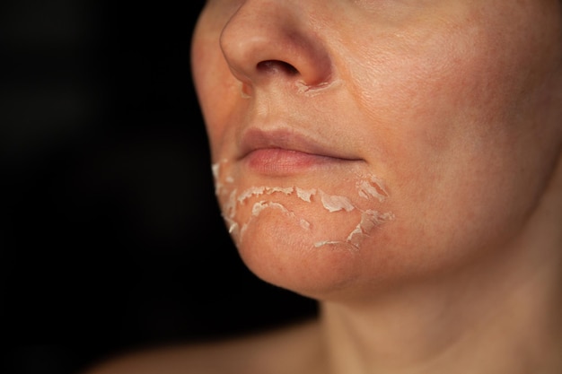 Das Gesicht einer Frau zeigt nach einem chemischen Peeling schuppige Haut im Gesicht