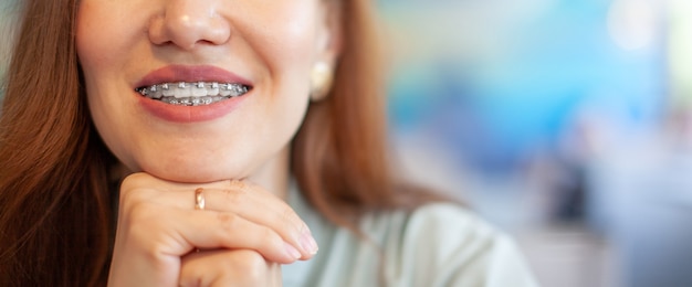 Das Lächeln eines jungen und schönen Mädchens mit Zahnspangen auf ihren weißen Zähnen. Begradigung schiefer Zähne mit Hilfe eines Bracketsystems. Malokklusion. Zahnpflege. Glatte Zähne und ein schönes Lächeln