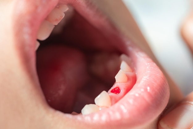 Das Mädchen öffnete den Mund, um nach dem Blut zu suchen, das durch das Mund- und Zahnpflegekonzept der lockeren Milchzähne verursacht wurde