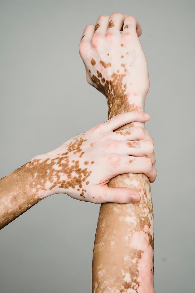 Foto das mãos de um paciente com vitiligo