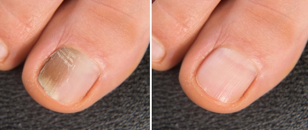 Foto dedo gordo del pie con uña afectada por onicomicosis primer plano antes y después del tratamiento con antifúngicos