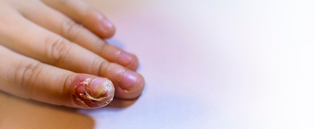 Dedo inchado com inflamação devido a infecção de unha rasgada mãos de crianças com uma lágrima perto da unha do dedo indicador a consequência de morder as unhas
