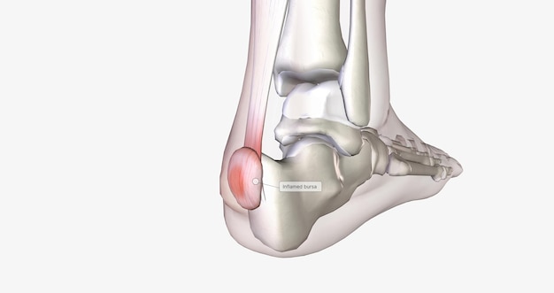 La deformidad de Haglund es un agrandamiento óseo en la parte posterior del talón que provoca bursitis dolorosa.