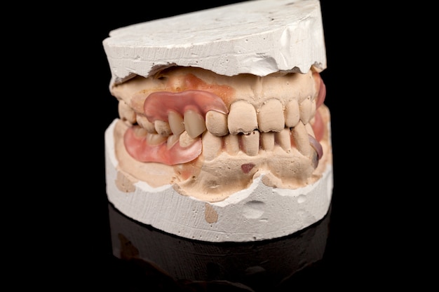 Dentaduras sobre yeso.