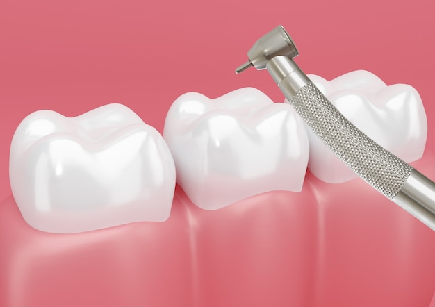 Dente do paciente tratado com broca para remoção de cáries.