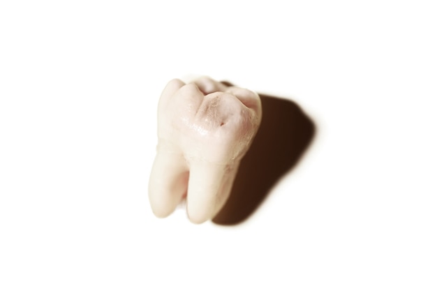 Dente do siso com cárie, fundo branco isolado. Terceiro molar removido afetado por cárie. Extrações dentárias.