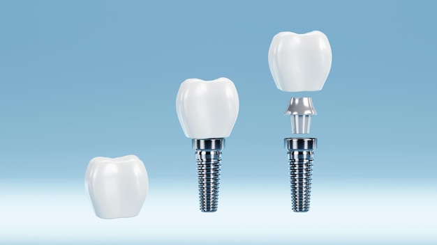 Dente e implante dentário para conjunto de estomatologia Conceito de cirurgia de implantes renderização em 3D