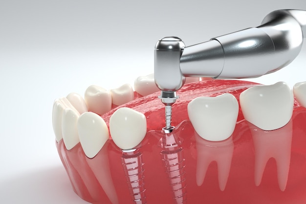 Dente implante humano Conceito de implantação dentária Dentes humanos ou dentaduras e ferramentas dentárias ilustração 3d