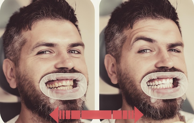 Dentes amarelos vs brancos antes ou depois de clarear o homem com fundo isolado tocando a boca com pai