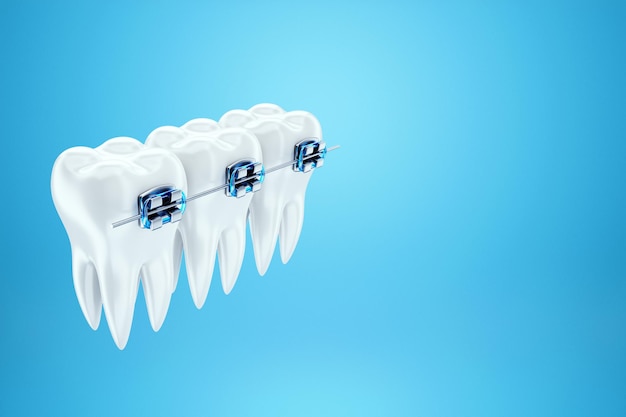 Dentes brancos com aparelho de metal em um fundo azul. Aparelho dentário, tratamento ortodôntico, odontologia, clareamento dos dentes, proteção, higiene bucal, higiene, saúde. Ilustração 3D, renderização 3D.