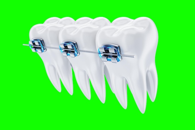 Dentes brancos com aparelho de metal em um fundo azul. Aparelho dentário, tratamento ortodôntico, odontologia, clareamento dos dentes, proteção, higiene bucal, higiene, saúde. Ilustração 3D, renderização 3D.