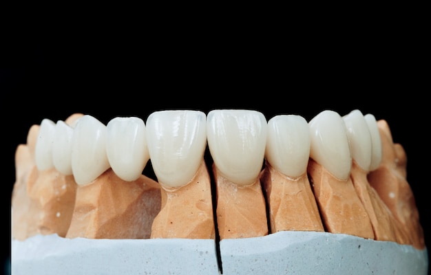 Foto dentes cerâmicos com implante em modelo de gesso