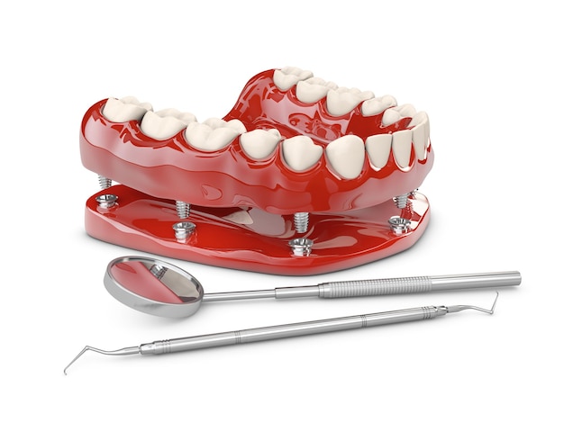 Foto dentes humanos e implantes dentários. ilustração 3d.