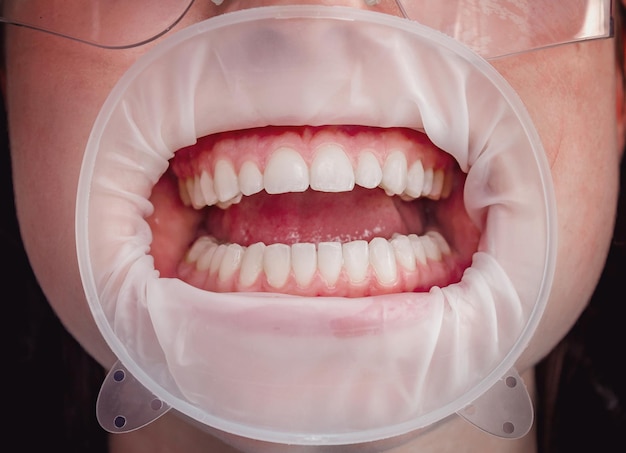 Dentes na boca na clínica odontológica a boca é aberta com um retrator de bochecha