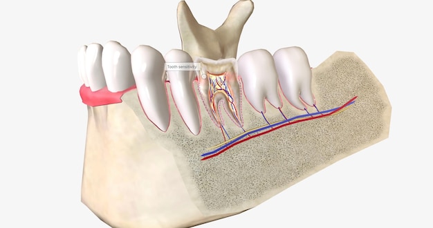 Dentes sensíveis é uma condição dental comum caracterizada por dor de dente aguda