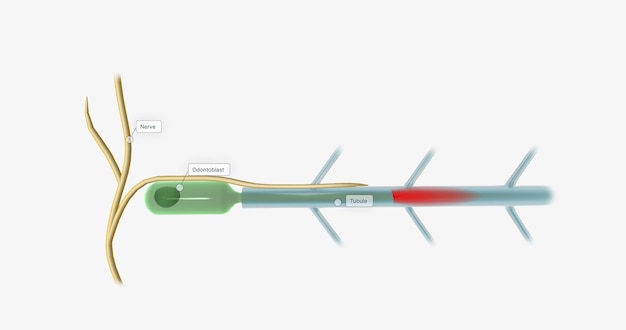 Dentin enthält Tausende von mit Flüssigkeit gefüllten Tubuli, die winzige Kanäle sind, die sich über die gesamte Dentinschicht erstrecken