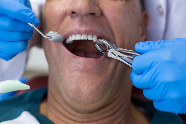 Dentista con alicates quirúrgicos para extraer un diente en descomposición