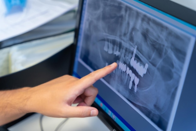 Dentista de la clínica dental explicando a un cliente los dientes que se implantarán con la computadora