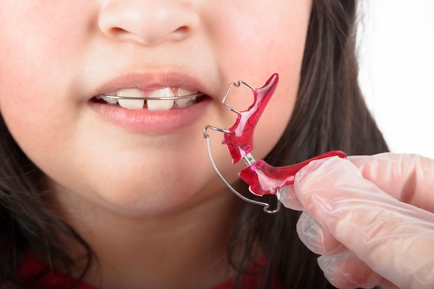Un dentista coloca aparatos de ortodoncia en los dientes de una niña para corregirlos