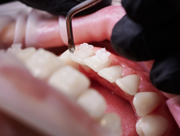 Dentista colocando aparatos ortopédicos blancos en los dientes del paciente