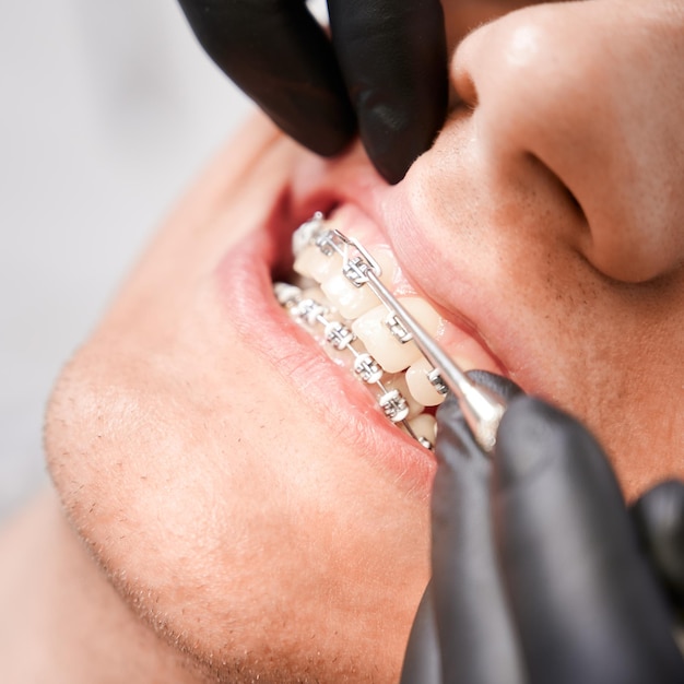 Dentista colocando bandas elásticas en aparatos ortopédicos de pacientes masculinos