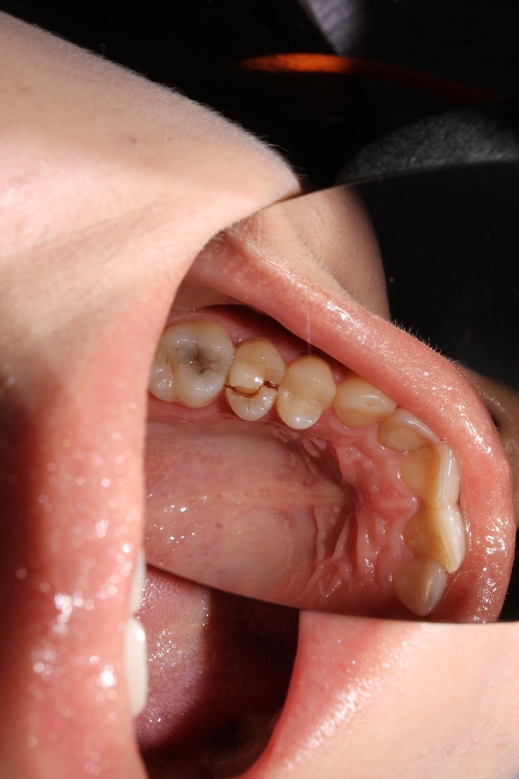 Foto dentista de cáries
