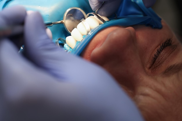 Foto el dentista instala carillas en los dientes del paciente