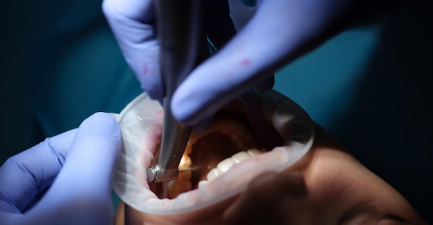 El dentista perfora el diente al paciente en una silla dental de primer plano