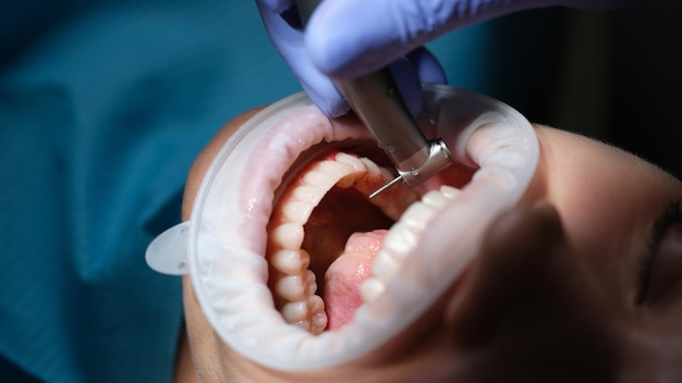 Dentista que trata los dientes del paciente con taladro en el primer plano de la clínica dental