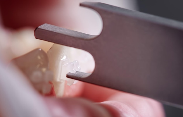 Dentista verificando a altura da colocação do bráquete com medidor dental