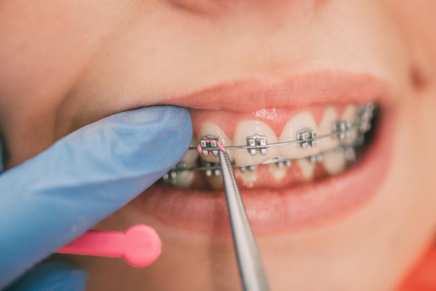 Foto dentista verificando o suporte no aparelho da paciente do sexo feminino. fechar-se. pessoas reais.