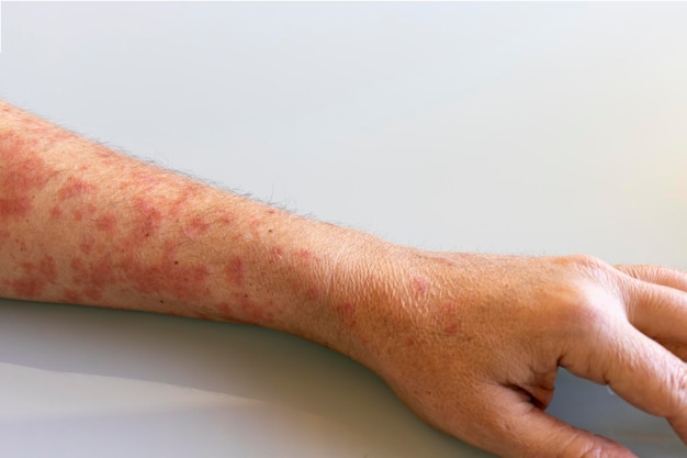 Der Arm des Mannes mit Herpesvirus-Hautflecken