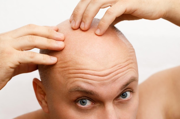 Der Kopf eines kahlköpfigen Mannes ein kahlköpfiger Mann war verärgert wegen der Behandlung von Haarausfall bei Kahlheit
