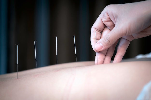 Foto der physiotherapeut macht akupunktur auf dem rücken eines weiblichen patienten