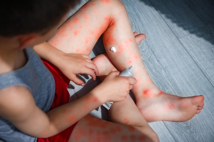 Foto dermatite atópica nas pernas de uma criança