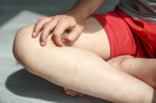 Dermatitis atópica en las piernas de un niño