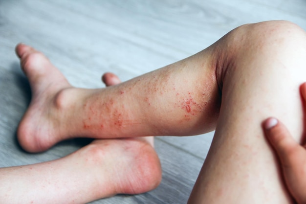 Dermatitis atópica en las piernas de un niño