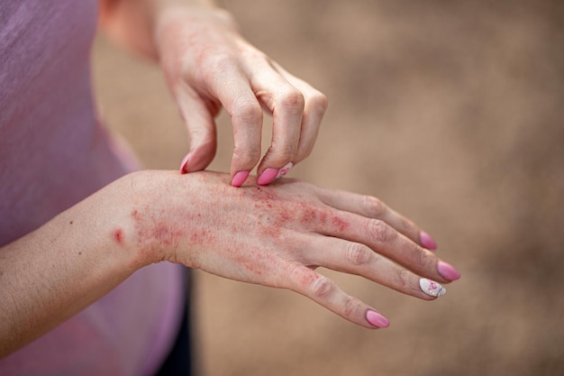 Dermatitis eccema en manos y pies manchas rojas en la piel piel secaEl concepto tratamiento dermatológico mujer fúngica rascándose la mano