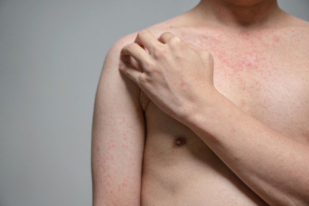 Dermatitis erupción enfermedad viral con inmunodeficiencia en el cuerpo de adultos jóvenes asiáticos, rascado con picazón, virus del sarampión, exantema viral