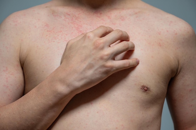 Dermatitis Hautausschlag Viruserkrankung mit Immunschwäche am Körper junger erwachsener Asiaten, Kratzen mit Juckreiz, Masernvirus, Virusexanthem