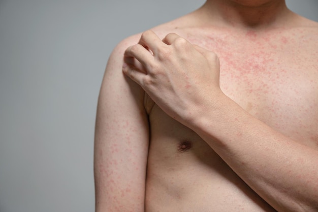 Dermatitis Hautausschlag Viruserkrankung mit Immunschwäche am Körper junger erwachsener Asiaten, Kratzen mit Juckreiz, Masernvirus, Virusexanthem